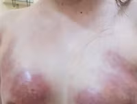 Hoại tử kinh hoàng trên cơ thể vì tiêm mỡ tự thân, chất làm đầy