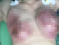 Hoại tử kinh hoàng trên cơ thể vì tiêm mỡ tự thân, chất làm đầy