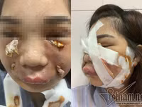 Hoại tử kinh hoàng trên cơ thể vì tiêm mỡ tự thân, chất làm đầy