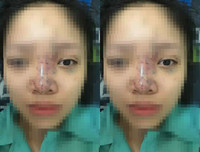 Hoại tử kinh hoàng trên cơ thể vì tiêm mỡ tự thân, chất làm đầy