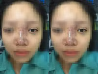 Hoại tử kinh hoàng trên cơ thể vì tiêm mỡ tự thân, chất làm đầy