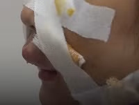 Hoại tử kinh hoàng trên cơ thể vì tiêm mỡ tự thân, chất làm đầy