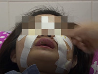 Hoại tử kinh hoàng trên cơ thể vì tiêm mỡ tự thân, chất làm đầy