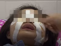 Hoại tử kinh hoàng trên cơ thể vì tiêm mỡ tự thân, chất làm đầy