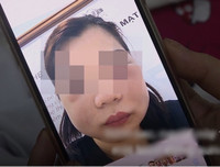 Hoại tử kinh hoàng trên cơ thể vì tiêm mỡ tự thân, chất làm đầy