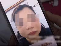 Hoại tử kinh hoàng trên cơ thể vì tiêm mỡ tự thân, chất làm đầy