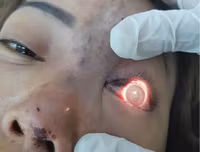 Hoại tử kinh hoàng trên cơ thể vì tiêm mỡ tự thân, chất làm đầy