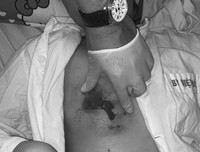 Hoại tử kinh hoàng trên cơ thể vì tiêm mỡ tự thân, chất làm đầy