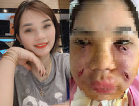 Hoại tử kinh hoàng trên cơ thể vì tiêm mỡ tự thân, chất làm đầy
