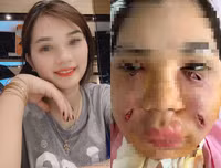 Hoại tử kinh hoàng trên cơ thể vì tiêm mỡ tự thân, chất làm đầy