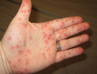 [ẢNH] Những thực phẩm tốt nhất cho bệnh nhân sốt xuất huyết