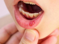 [ẢNH] Những giải pháp tự nhiên giúp điều trị nhiệt miệng cực hiệu quả