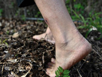 [ẢNH] Những điều cần biết về Whitmore- Bệnh truyền nhiễm có nguy cơ gây tử vong