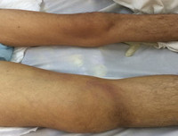 [ẢNH] Những điều cần biết về Whitmore- Bệnh truyền nhiễm có nguy cơ gây tử vong