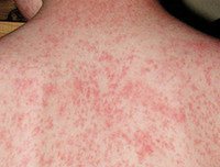 [ẢNH] Cảnh báo những căn bệnh dễ mắc phải khi trời nồm ẩm và cách phòng tránh