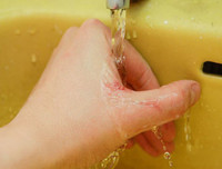 Quy trình xử lý chống phơi nhiễm HIV