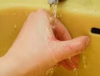 Quy trình xử lý chống phơi nhiễm HIV