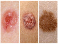 7 tác hại đáng sợ của tia UV đối với cơ thể