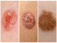 7 tác hại đáng sợ của tia UV đối với cơ thể