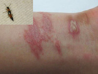 [ẢNH] Mẹo xử lý ban đầu khi bị côn trùng cắn