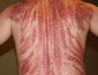 [ẢNH] Sốt xuất huyết vào mùa: Những điều kiêng kỵ khi chữa trị