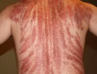 [ẢNH] Sốt xuất huyết vào mùa: Những điều kiêng kỵ khi chữa trị