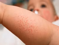 [ẢNH] Sốt xuất huyết vào mùa: Những điều kiêng kỵ khi chữa trị