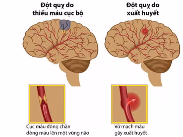8 cách giúp bạn tránh xa nguy cơ đột quỵ ảnh 1