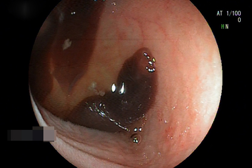 Gắp thành công ổ sán lá ruột cho người phụ nữ ảnh 1