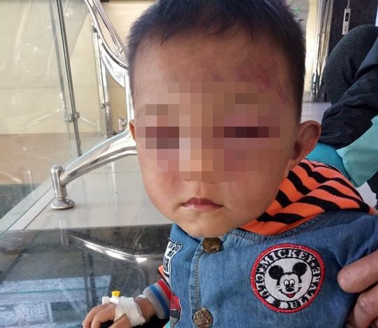 Xót xa bé hai tuổi bị cha dượng đánh tím mặt ảnh 1 Xót xa bé hai tuổi bị cha dượng đánh tím mặt ảnh 1