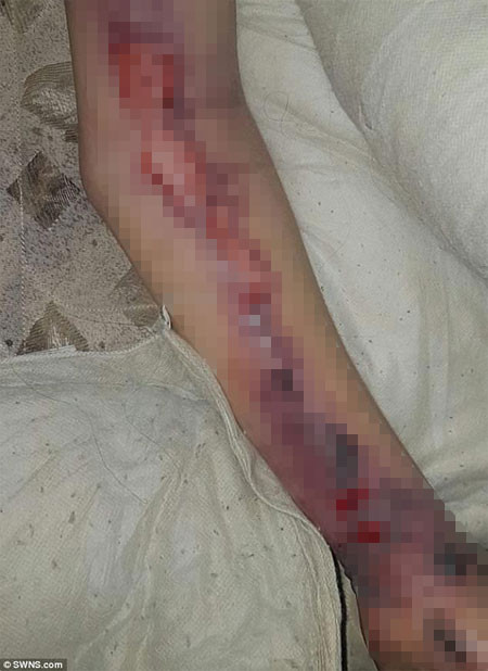 Một bà mẹ trẻ bị nhiễm vi khuẩn ăn thịt người ảnh 2