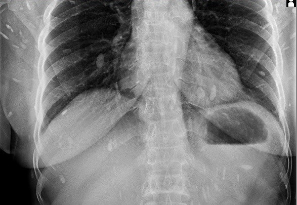 Nghệ An: Người phụ nữ phải nhập viện vì nhiễm sán lá gan ảnh 1 Nghệ An: Người phụ nữ phải nhập viện vì nhiễm sán lá gan ảnh 1