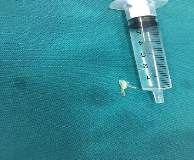 Bé trai 10 tháng tuổi hóc xương cá phải nhập viện ảnh 1