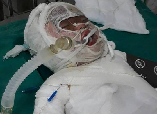 Thương xót bé gái 3 tuổi bị bỏng nặng khi rơi vào hố vôi đang sôi ảnh 1