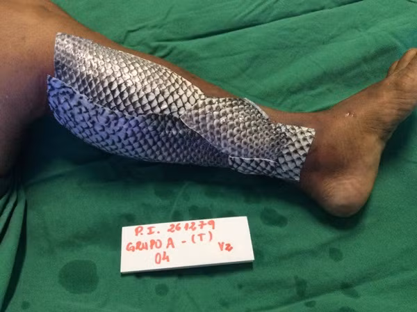 Người phụ nữ được chữa bỏng bằng da cá rô phi ảnh 3