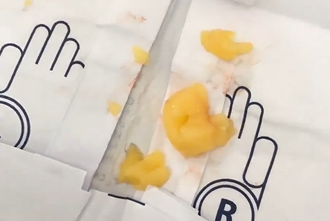 Cứu sống bé trai bị ngưng tim do hóc thạch rau câu ảnh 1