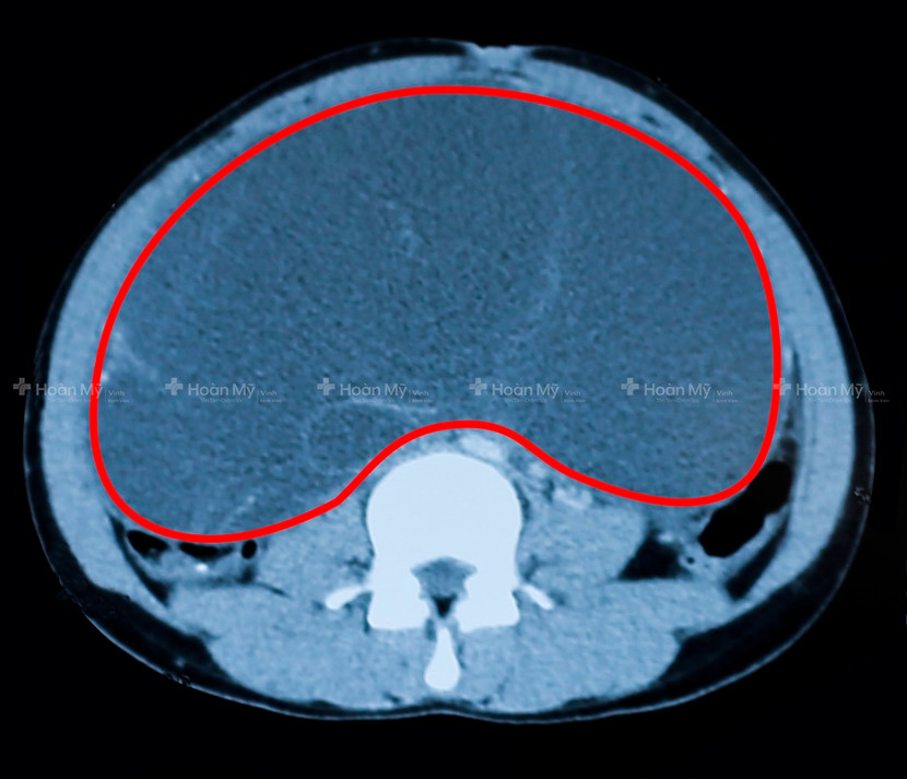 Phẫu thuật bóc thành công khối u nang buồng trứng to như quả bóng cho cô gái 21 tuổi ảnh 1