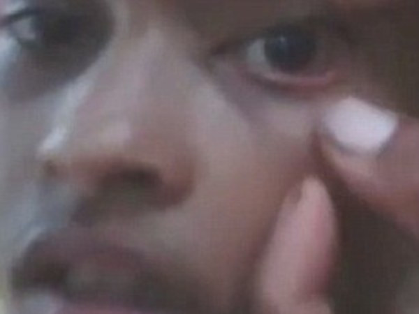 Ấn Độ: Bác sĩ hốt hoảng phát hiện cả ổ kiến trong mắt bé gái 11 tuổi ảnh 1 Ấn Độ: Bác sĩ hốt hoảng phát hiện cả ổ kiến trong mắt bé gái 11 tuổi ảnh 1