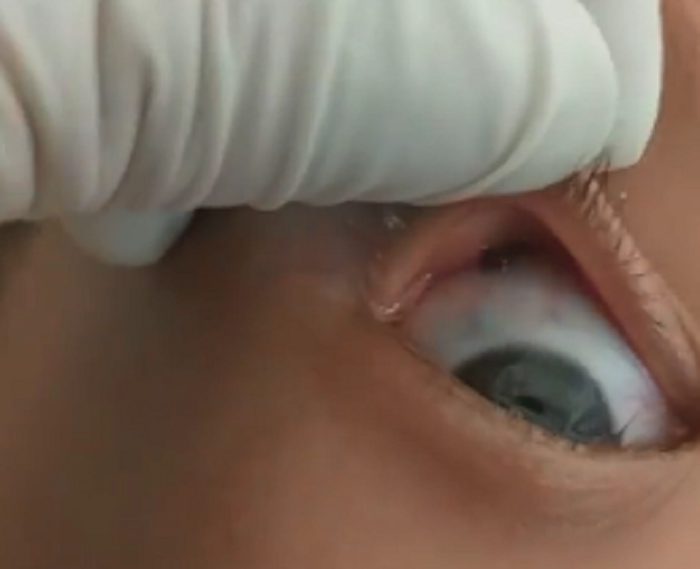 Gắp thành công con vắt sống trong mắt bé gái người H'Mông ảnh 1