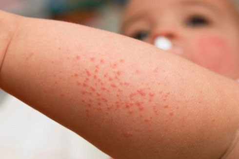 Nắng nóng, cẩn trọng khi trẻ bị nhiễm khuẩn do ban nhiệt ảnh 1