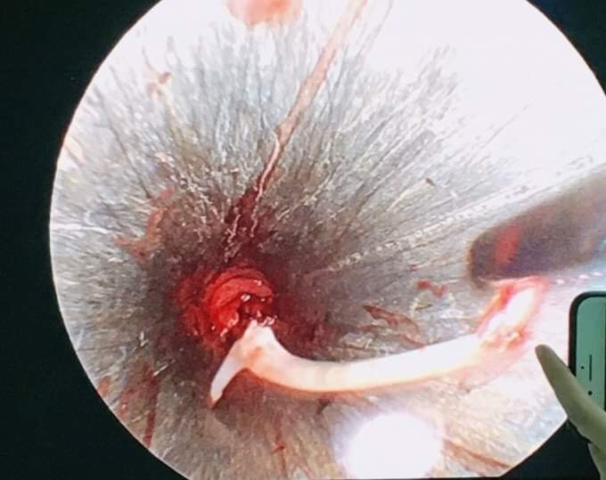 Suýt mất mạng vì uống 'nước thần' chữa hóc xương cá ảnh 1 Suýt mất mạng vì uống 'nước thần' chữa hóc xương cá ảnh 1