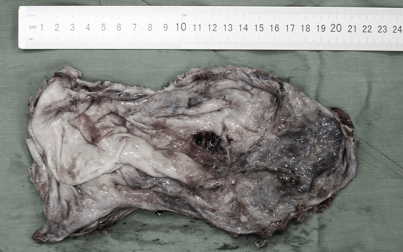 Phẫu thuật bóc thành công khối u nang buồng trứng to như quả bóng cho cô gái 21 tuổi ảnh 2