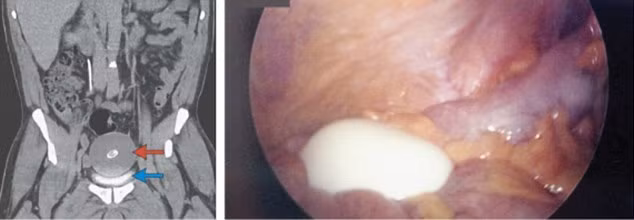Phát hiện “quả trứng luộc” trong bàng quang một người đàn ông ảnh 1
