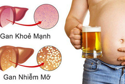 Mỡ bụng - "kẻ giết người" thầm lặng ảnh 1