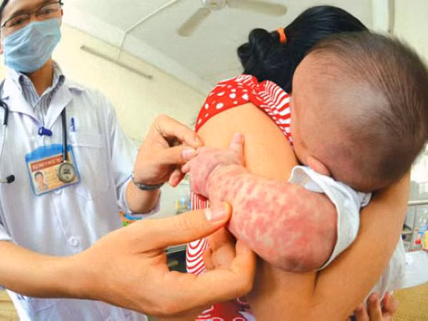 Hà Nội ghi nhận rải rác bệnh nhân mắc sởi ảnh 1