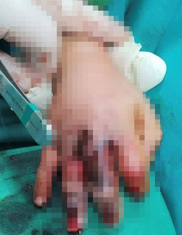 Máy ép mía kẹp dập bàn tay bé 4 tuổi ảnh 1 Máy ép mía kẹp dập bàn tay bé 4 tuổi ảnh 1