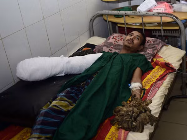 "Người cây" phẫu thuật loại bỏ 5kg "vỏ" ảnh 1