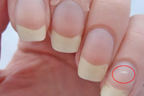 Nhận biết dấu hiệu của bệnh từ những đốm trắng trên móng tay ảnh 1