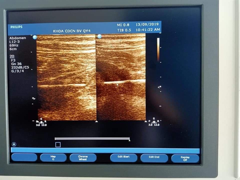 Ngủ quên, người đàn ông nuốt que tăm nhọn vào bụng ảnh 1