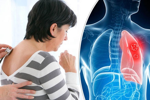 Dấu hiệu ung thư phổi không nên bỏ qua ảnh 1